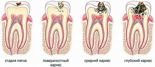 КАРИЕС